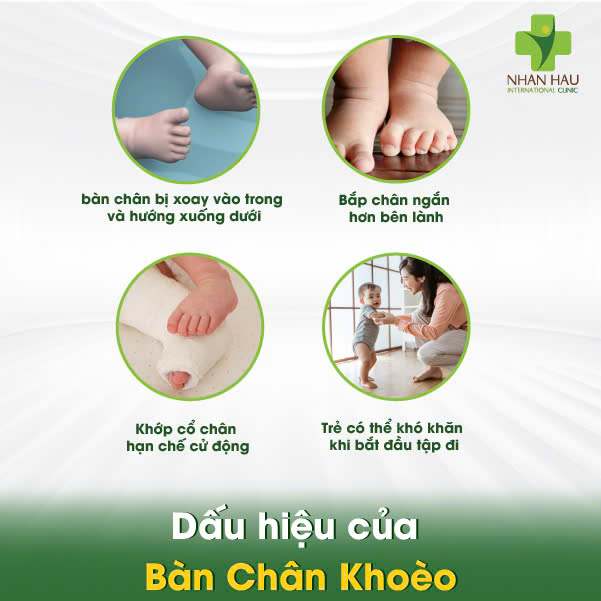 Bàn Chân Khoèo: Nguyên Nhân, Dấu Hiệu và Điều Trị Hiệu Quả 3 Dấu hiệu của Bàn Chân Khoèo