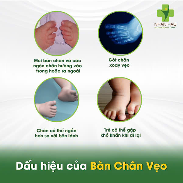 Bàn Chân Vẹo: Nguyên Nhân, Dấu Hiệu và Điều Trị Hiệu Quả 3 Dấu hiệu của Bàn Chân Vẹo