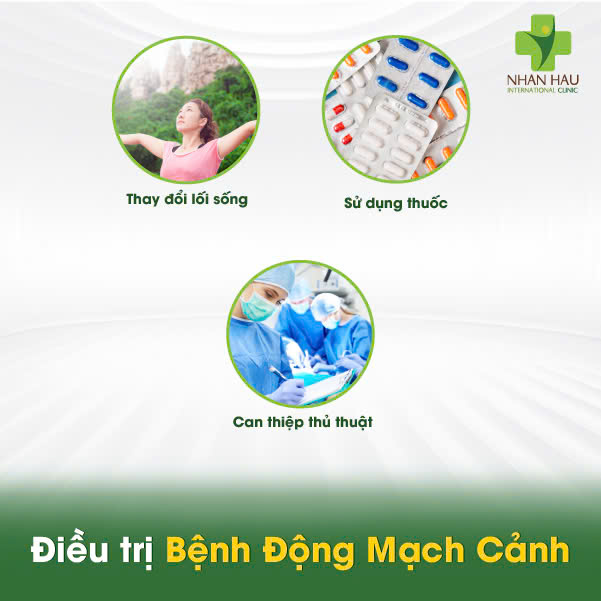 Bệnh Động Mạch Cảnh: Nguyên Nhân, Triệu Chứng và Phòng Ngừa 6 Điều trị Bệnh Động Mạch Cảnh