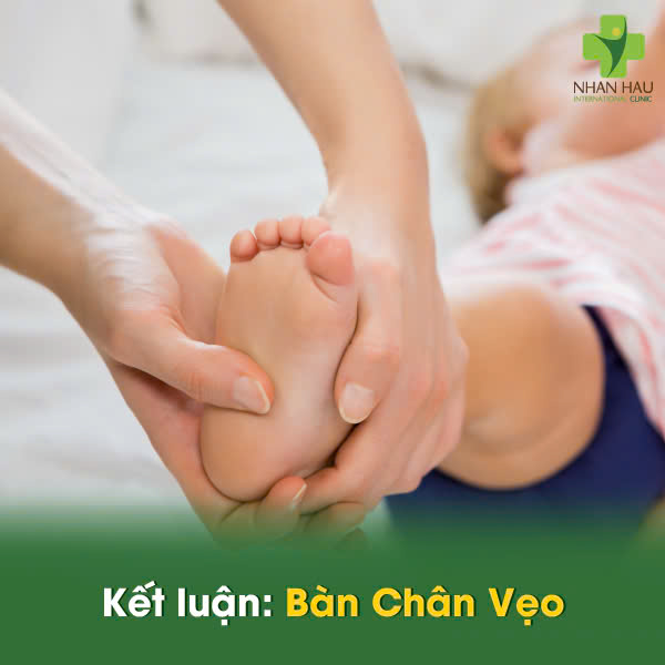Bàn Chân Vẹo: Nguyên Nhân, Dấu Hiệu và Điều Trị Hiệu Quả 7 Kết luận: Bàn Chân Vẹo
