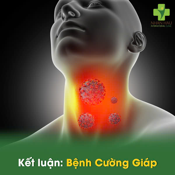 Bệnh Cường Giáp: Nguyên Nhân, Triệu Chứng và Điều Trị Hiệu Quả 8 Kết luận: Bệnh Cường Giáp