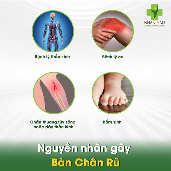 Bàn Chân Rũ: Nguyên Nhân, Triệu Chứng và Điều Trị Hiệu Quả 2 Nguyên nhân gây Bàn Chân Rũ