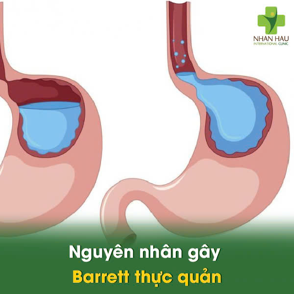 Barrett thực quản: Nguyên nhân, Triệu chứng và Cách Kiểm soát 2 Nguyên nhân gây Barrett thực quản