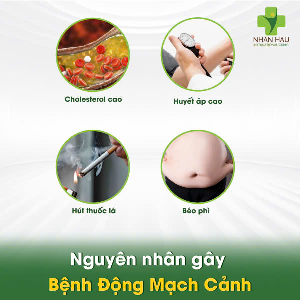 Bệnh Động Mạch Cảnh: Nguyên Nhân, Triệu Chứng và Phòng Ngừa 2 Nguyên nhân gây Bệnh Động Mạch Cảnh
