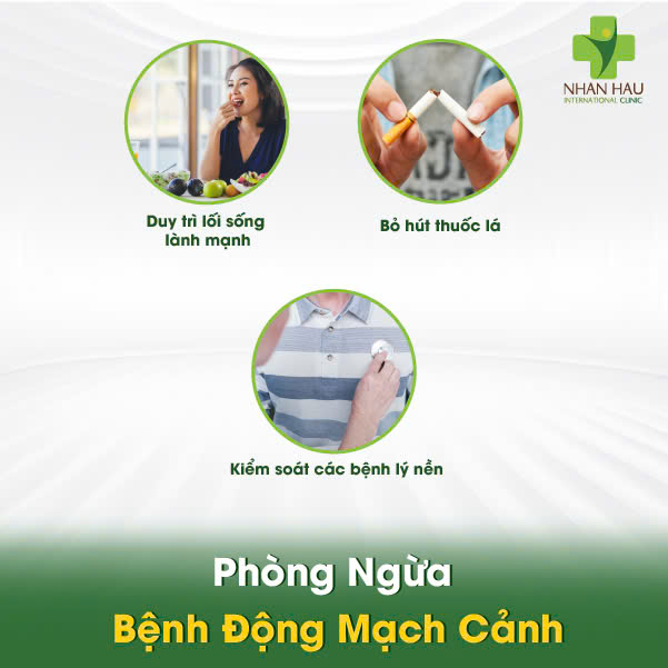 Bệnh Động Mạch Cảnh: Nguyên Nhân, Triệu Chứng và Phòng Ngừa 7 Phòng Ngừa Bệnh Động Mạch Cảnh