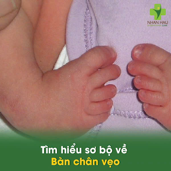 Bàn Chân Vẹo: Nguyên Nhân, Dấu Hiệu và Điều Trị Hiệu Quả 1 Tìm hiểu sơ bộ về Bàn chân vẹo