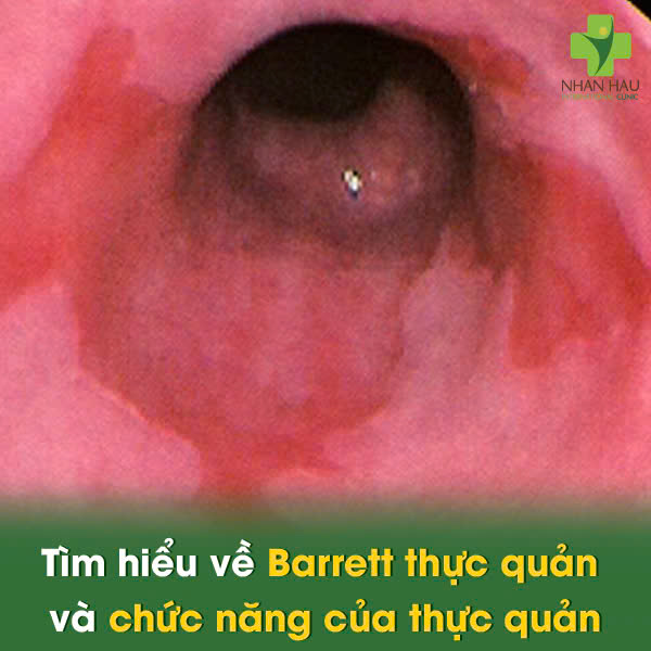 Barrett thực quản: Nguyên nhân, Triệu chứng và Cách Kiểm soát 1 Tìm hiểu về Barrett thực quản và chức năng của thực quản