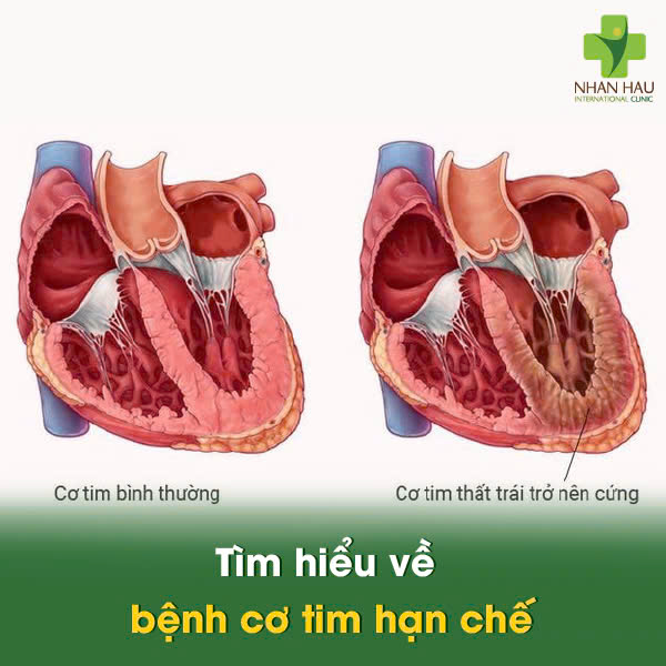 Bệnh Cơ Tim Hạn Chế: Dấu Hiệu, Nguyên Nhân và Điều Trị 1 Tìm hiểu về bệnh cơ tim hạn chế