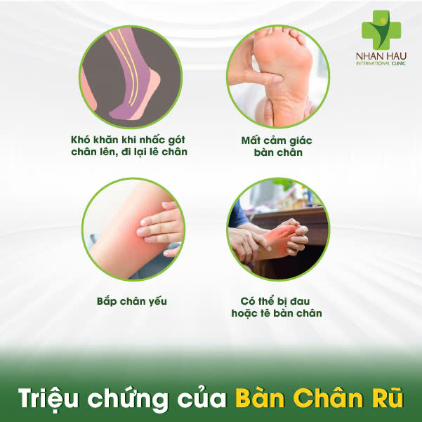 Bàn Chân Rũ: Nguyên Nhân, Triệu Chứng và Điều Trị Hiệu Quả 3 Triệu chứng của Bàn Chân Rũ