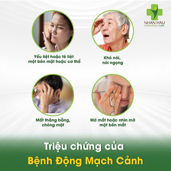 Bệnh Động Mạch Cảnh: Nguyên Nhân, Triệu Chứng và Phòng Ngừa 3 Triệu chứng của Bệnh Động Mạch Cảnh