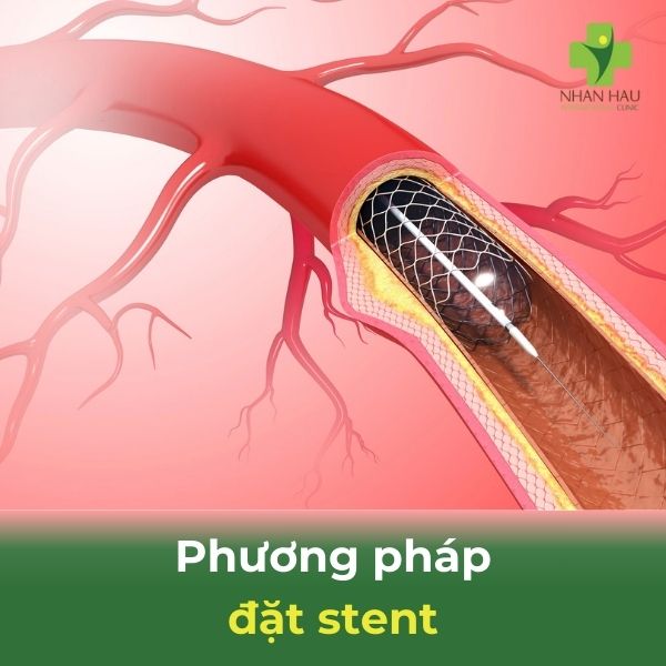 Tai biến nhẹ ở người già: Nguyên nhân, triệu chứng và cách phòng ngừa 3 phương pháp đặt stent