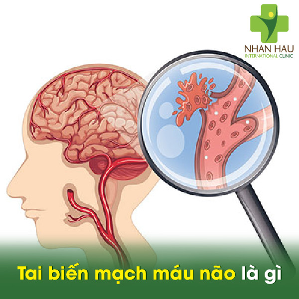 Tai biến mạch máu não là gì