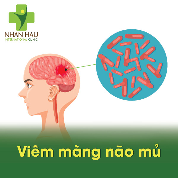 Vì sao xuất hiện căn bệnh viêm màng não mủ