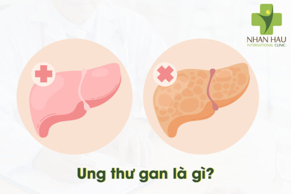 ung thư gan là gì