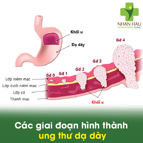 Các giai đoạn hình thành ung thư dạ dày