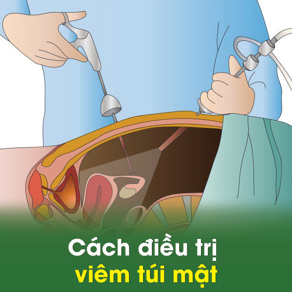 Cách điều trị viêm túi mật