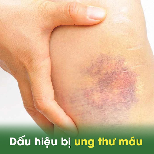 Dấu hiệu bị ung thư máu