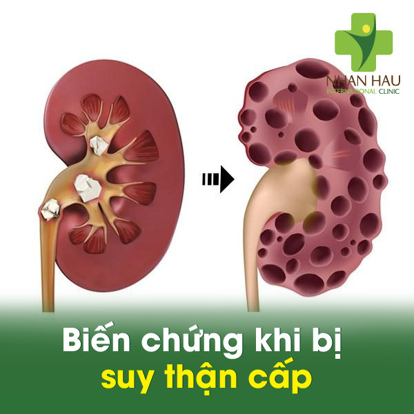Biến chứng khi bị suy thận cấp