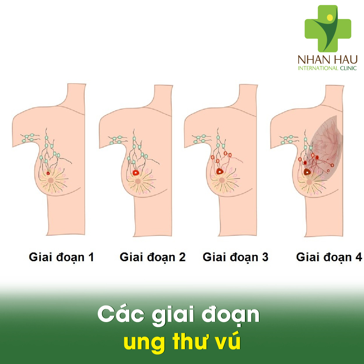 Các giai đoạn ung thư vú