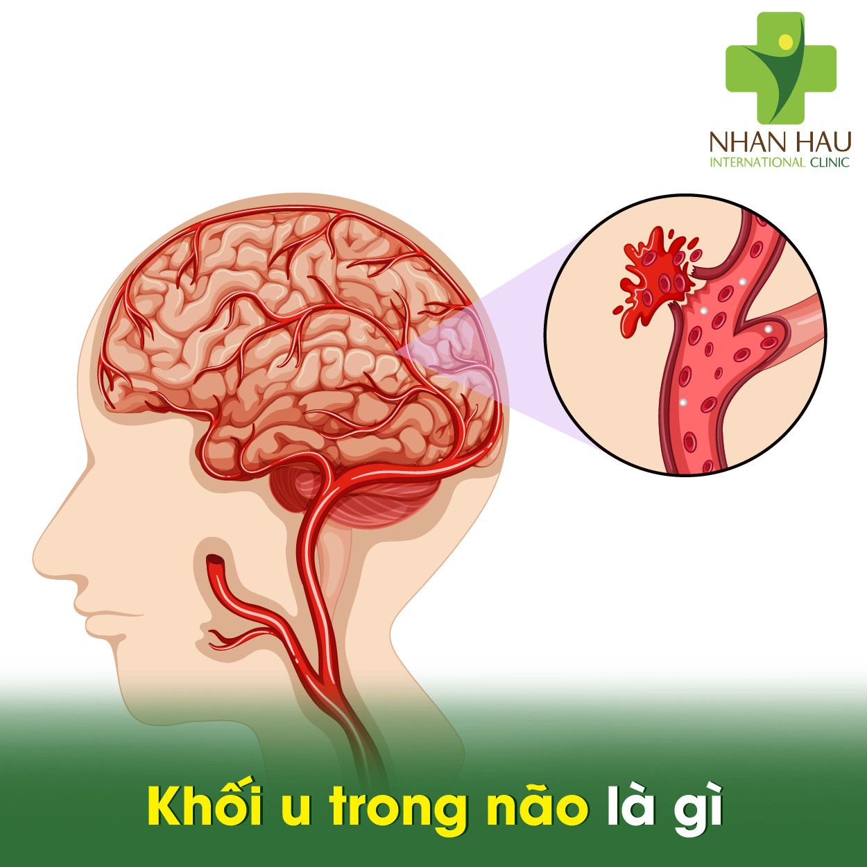Khối u trong não là gì