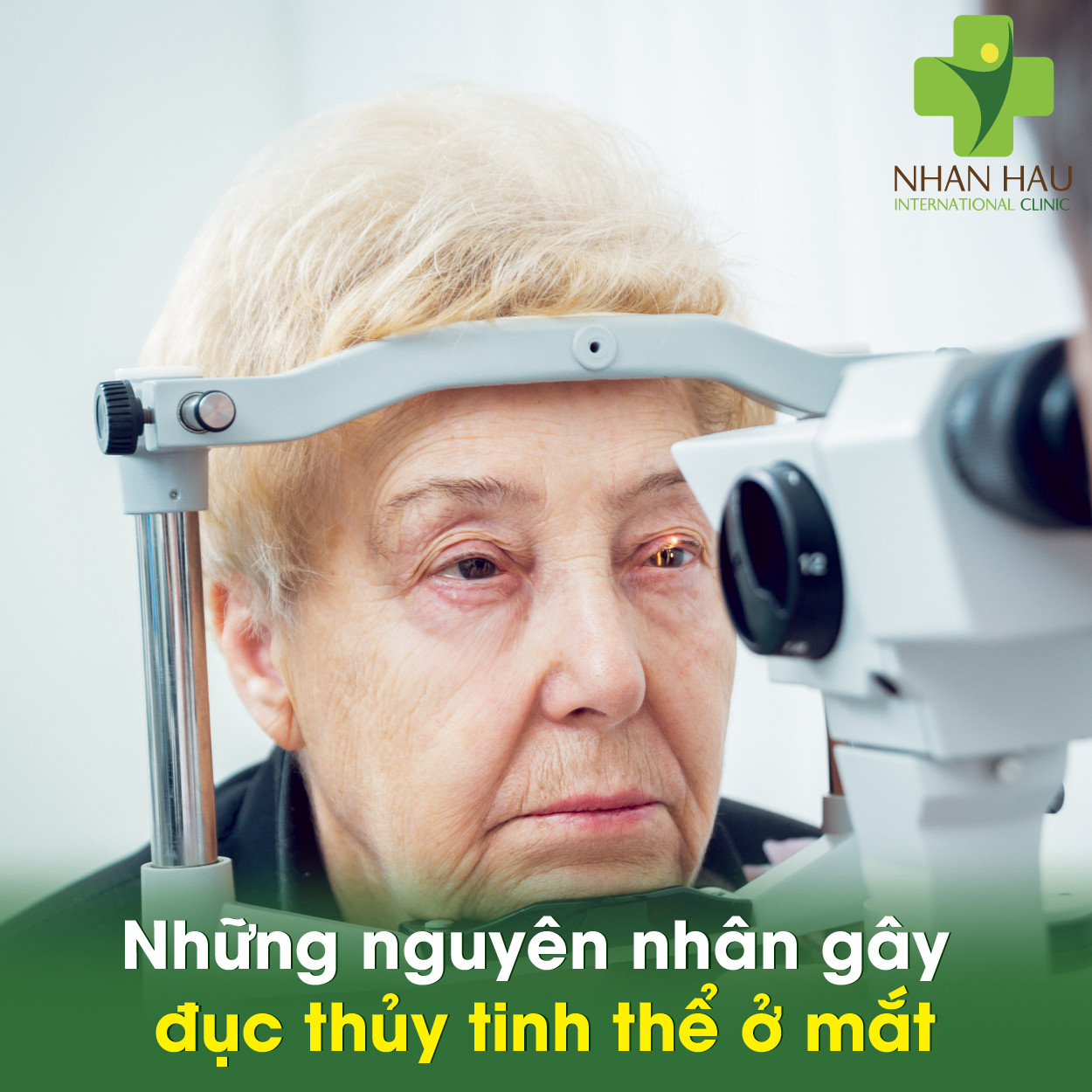 Những nguyên nhân gây đục thủy tinh thể ở mắt