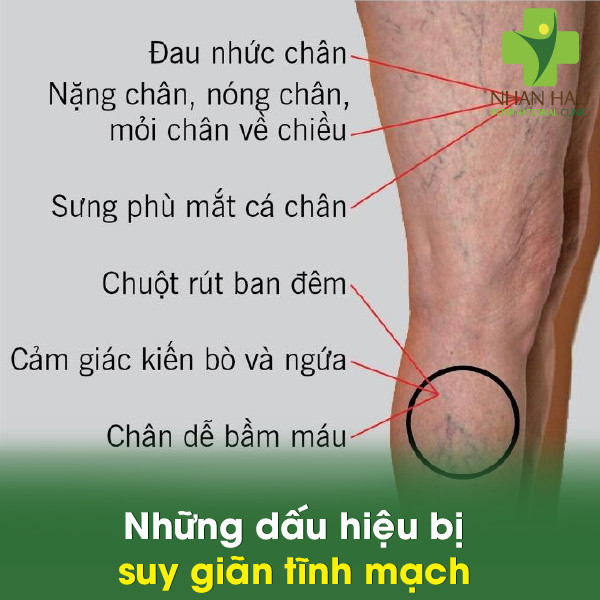 Những dấu hiệu bị suy giãn tĩnh mạch