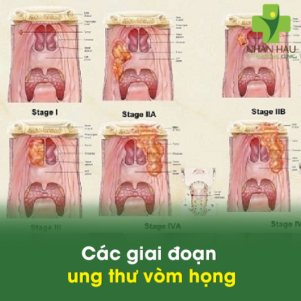 Các giai đoạn ung thư vòm họng