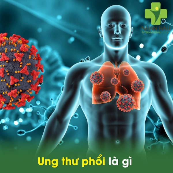 Ung thư phổi là gì