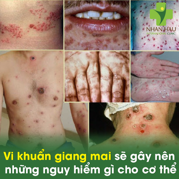 Vi khuẩn giang mai sẽ gây nên những nguy hiểm gì cho cơ thể