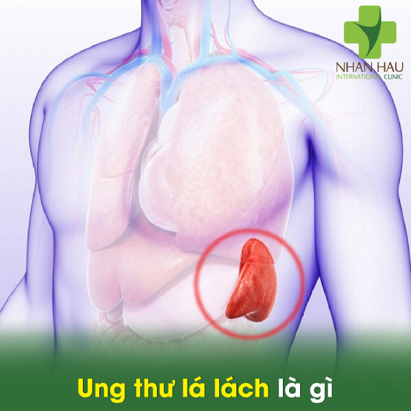 Ung thư lá lách là gì
