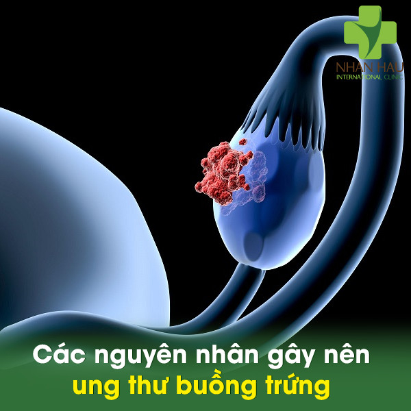 Các nguyên nhân gây nên ung thư buồng trứng