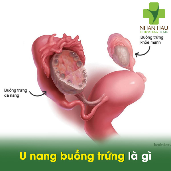 U nang buồng trứng là gì