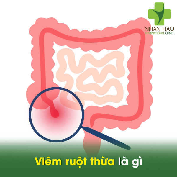 Viêm ruột thừa là gì