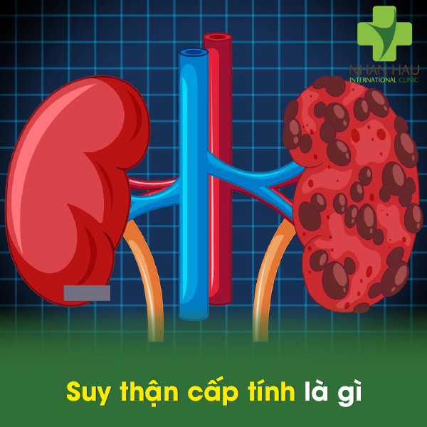 Suy thận cấp tính là gì