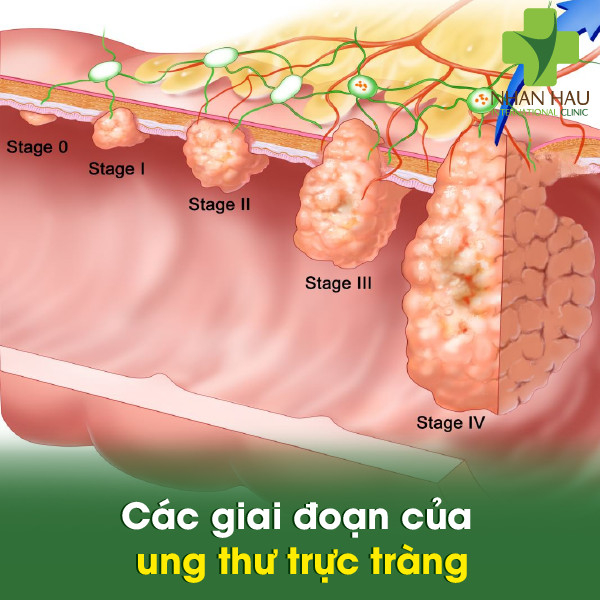 Các giai đoạn của ung thư trực tràng