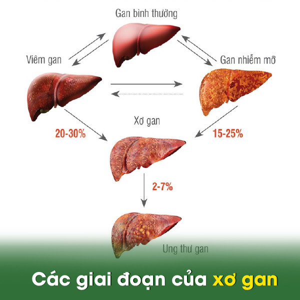Các giai đoạn của xơ gan