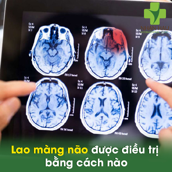 Lao màng não được điều trị bằng cách nào