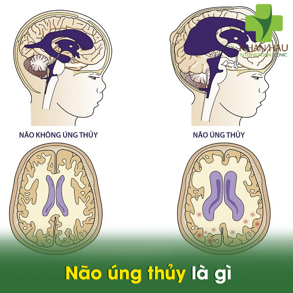 Não úng thủy là gì
