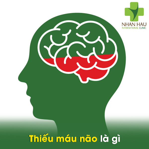 Thiếu máu não là gì