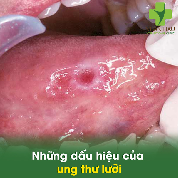 Những dấu hiệu của ung thư lưỡi