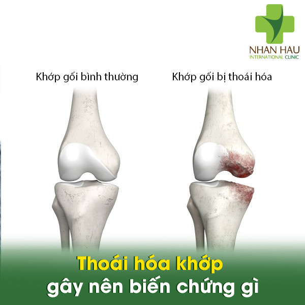Thoái hóa khớp gây nên biến chứng gì