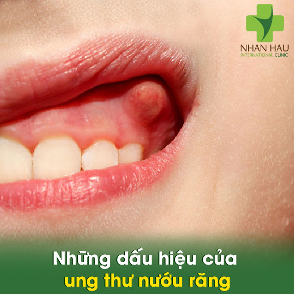 Những dấu hiệu của ung thư nướu răng