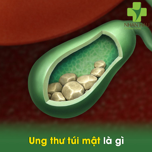 Ung thư túi mật là gì