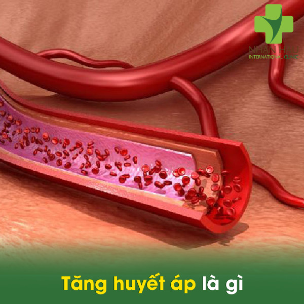 Tăng huyết áp là gì