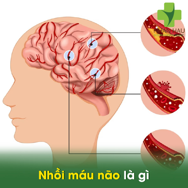 Nhồi máu não là gì