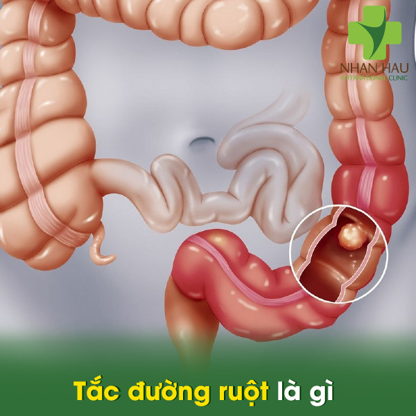 Tắc đường ruột là gì