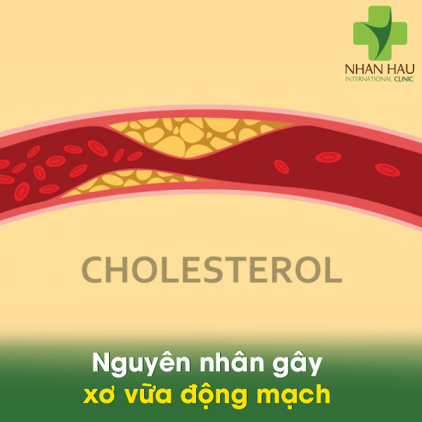 Nguyên nhân gây xơ vữa động mạch