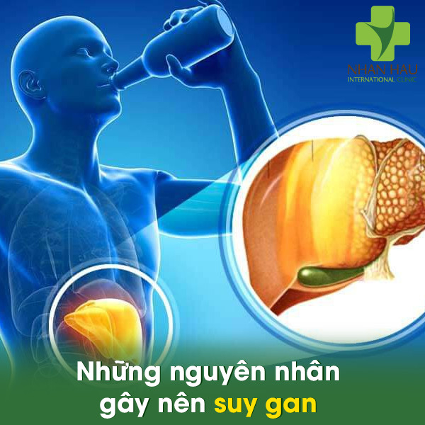 Những nguyên nhân gây nên suy gan