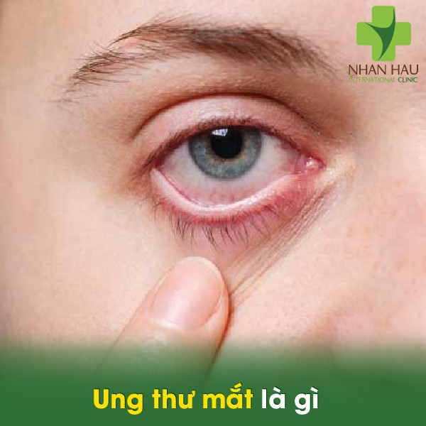 Ung thư mắt là gì