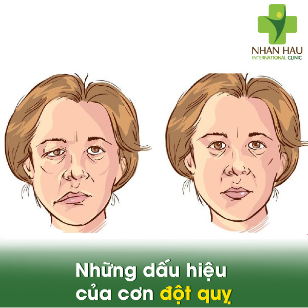 Những dấu hiệu của cơn đột quỵ